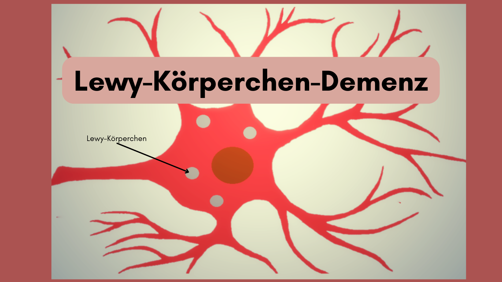 Lewy Körperchen Demenz 5800